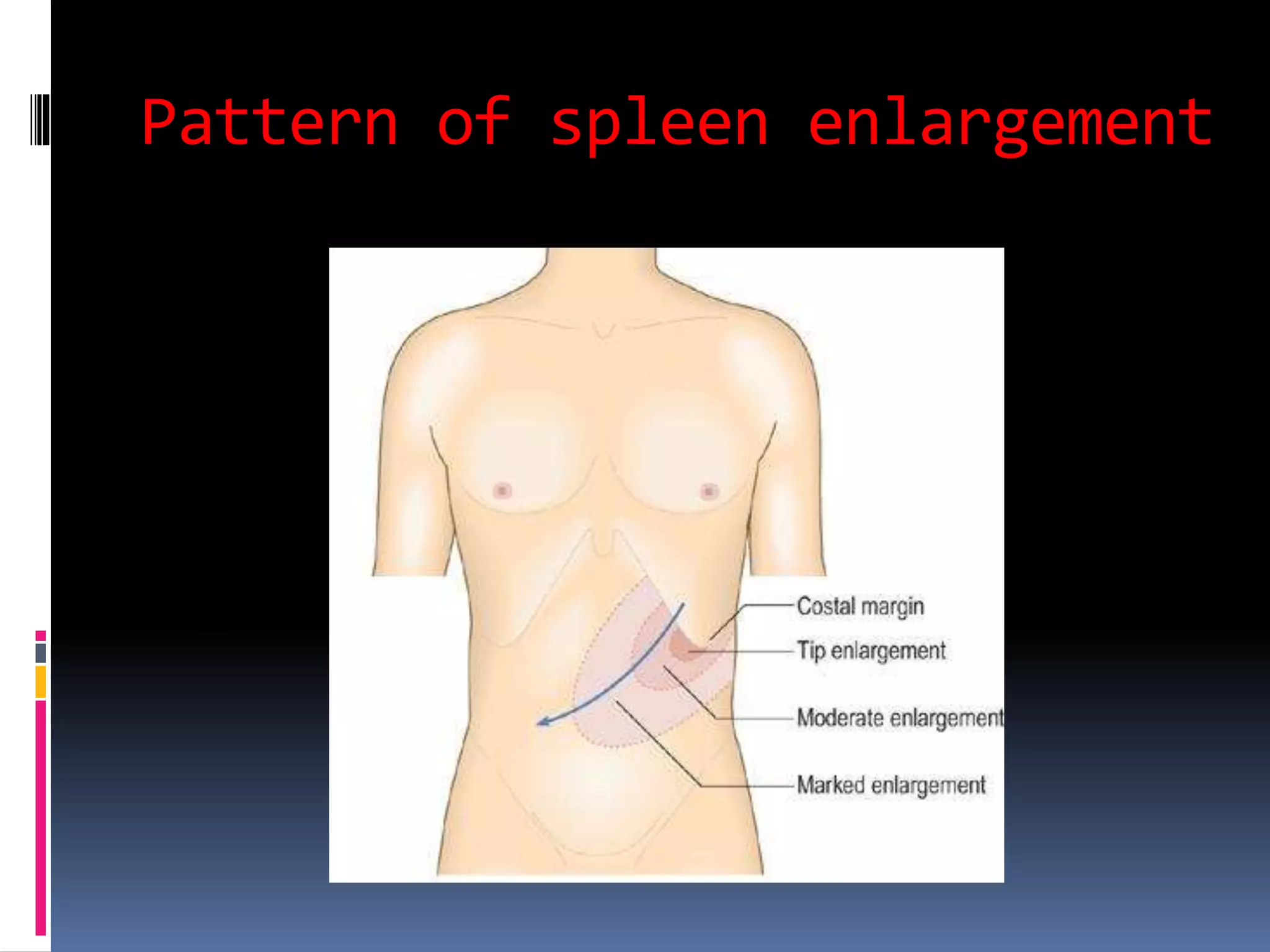 Pattern of spleen enlargement
 