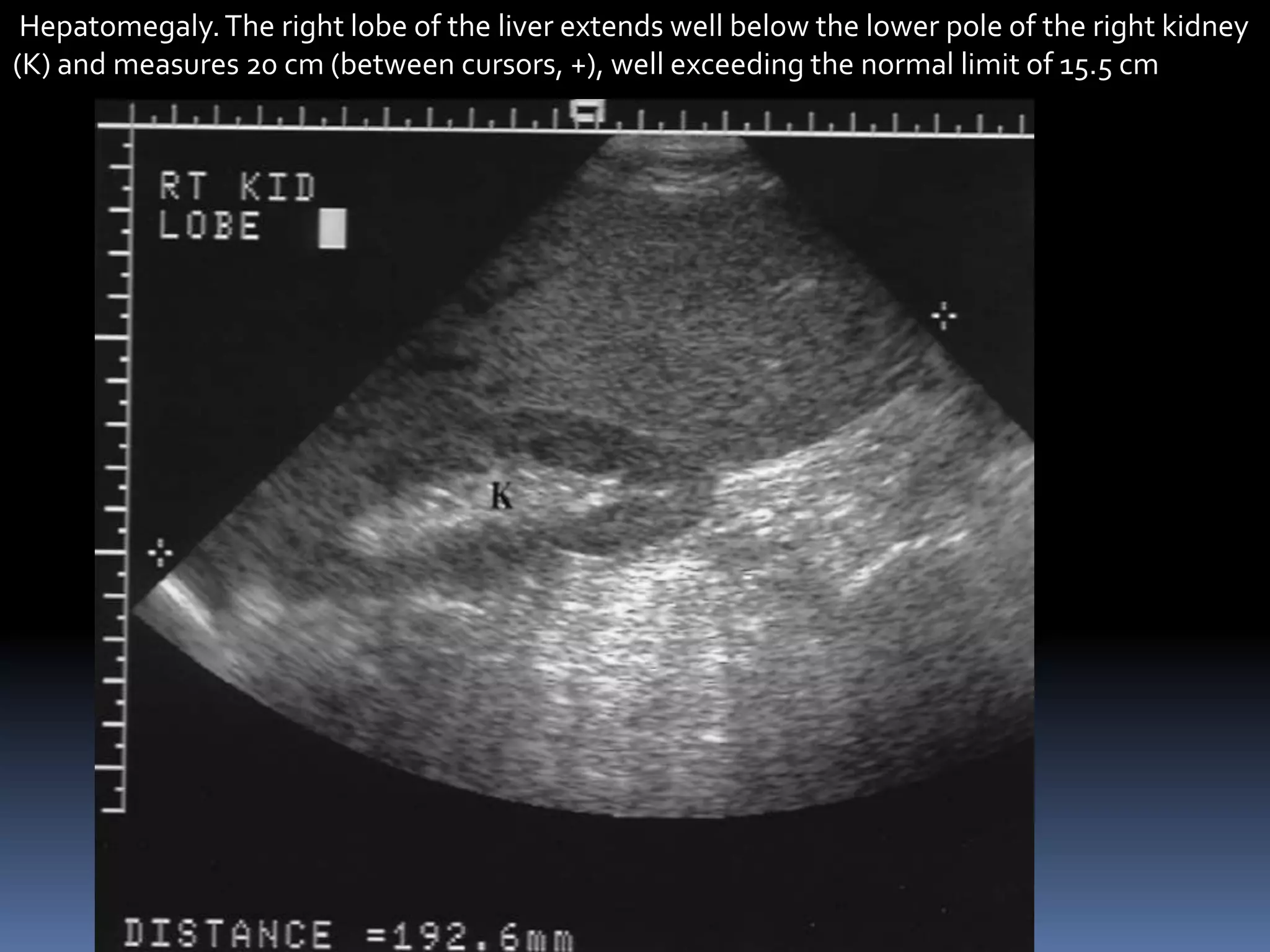 Hepatomegaly.The right lobe of the liver extends well below the lower pole of the right kidney
(K) and measures 20 cm (between cursors, +), well exceeding the normal limit of 15.5 cm
 