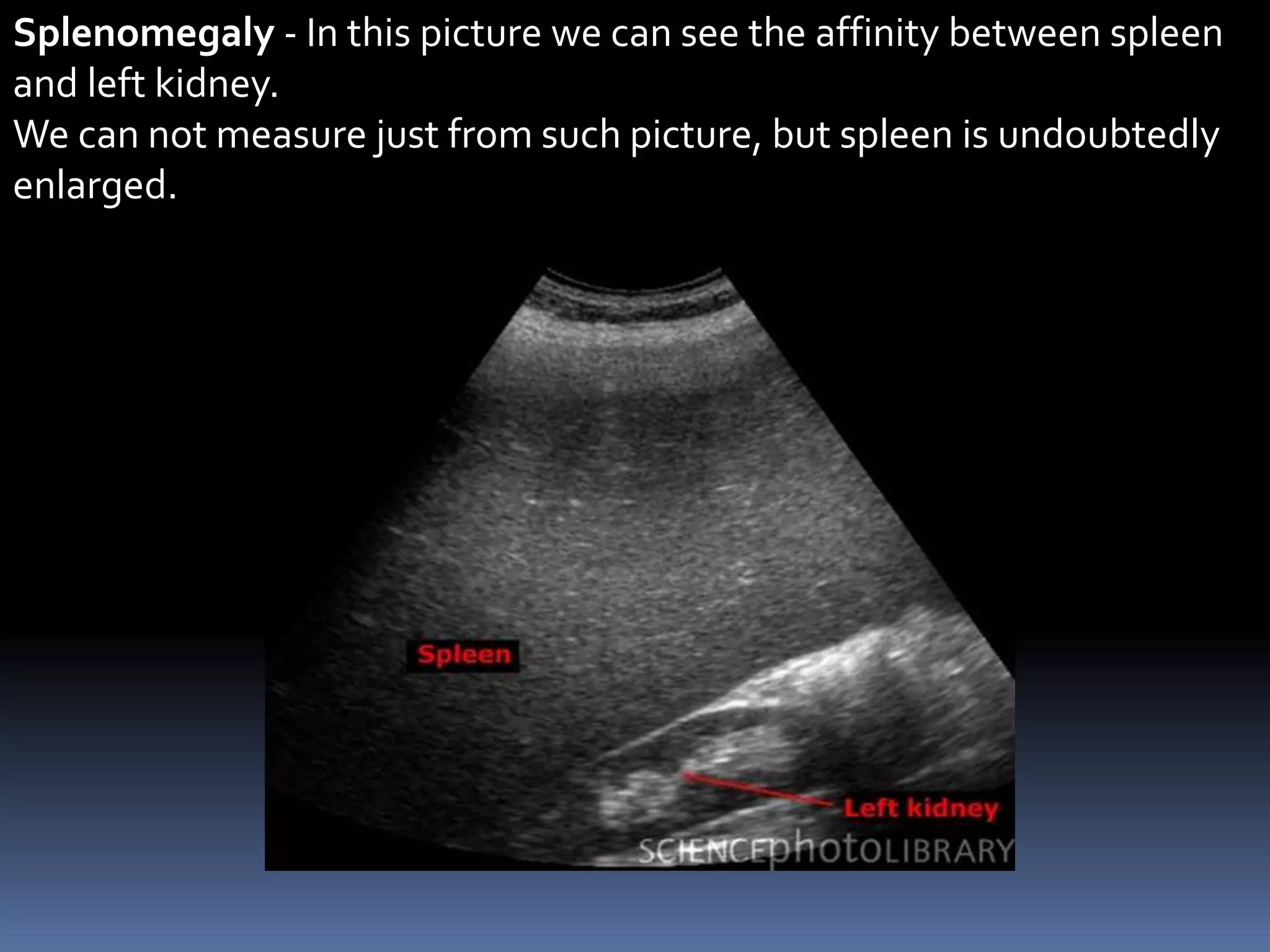Splenomegaly - In this picture we can see the affinity between spleen
and left kidney.
We can not measure just from such picture, but spleen is undoubtedly
enlarged.
 
