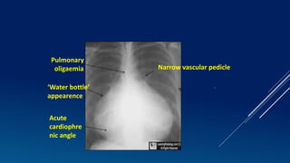 An approach to cardiac xray Dr. Muhammad Bin Zulfiqar | PPTX