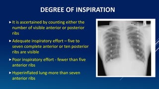 Inspiration Normal Ribs An approach to cardiac xray Dr. Muhammad Bin Zulfiqar | PPTX