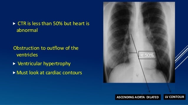 An Approach To Cardiac Xray Dr Muhammad Bin Zulfiqar
