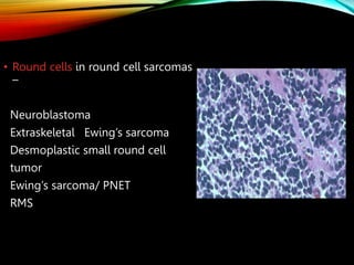 Pnet Sarcoma An approach to diagonosis of soft tissue sarcoma.pptx