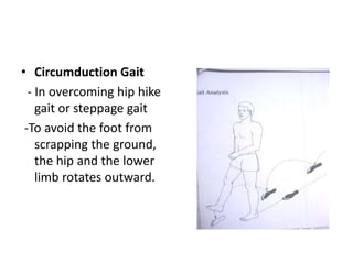 • Circumduction Gait
- In overcoming hip hike
gait or steppage gait
-To avoid the foot from
scrapping the ground,
the hip and the lower
limb rotates outward.
 