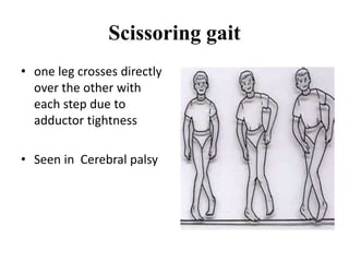 Scissoring gait
• one leg crosses directly
over the other with
each step due to
adductor tightness
• Seen in Cerebral palsy
 
