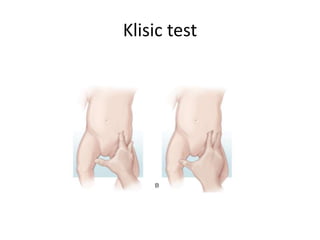 Klisic test
 