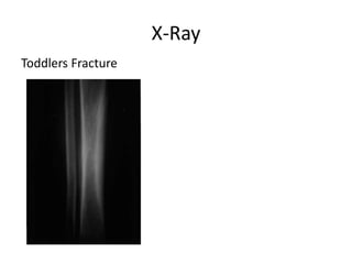 X-Ray
Toddlers Fracture
 