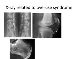 X-ray related to overuse syndrome
 