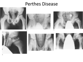 Perthes Disease
 
