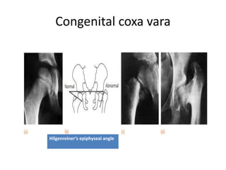 Congenital coxa vara
Hilgenreiner’s epiphyseal angle
 
