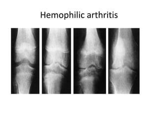 Hemophilic arthritis
 