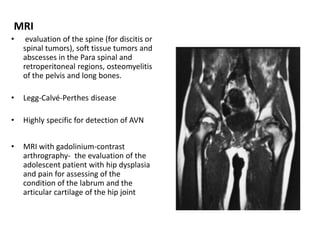 MRI
• evaluation of the spine (for discitis or
spinal tumors), soft tissue tumors and
abscesses in the Para spinal and
retroperitoneal regions, osteomyelitis
of the pelvis and long bones.
• Legg-Calvé-Perthes disease
• Highly specific for detection of AVN
• MRI with gadolinium-contrast
arthrography- the evaluation of the
adolescent patient with hip dysplasia
and pain for assessing of the
condition of the labrum and the
articular cartilage of the hip joint
 