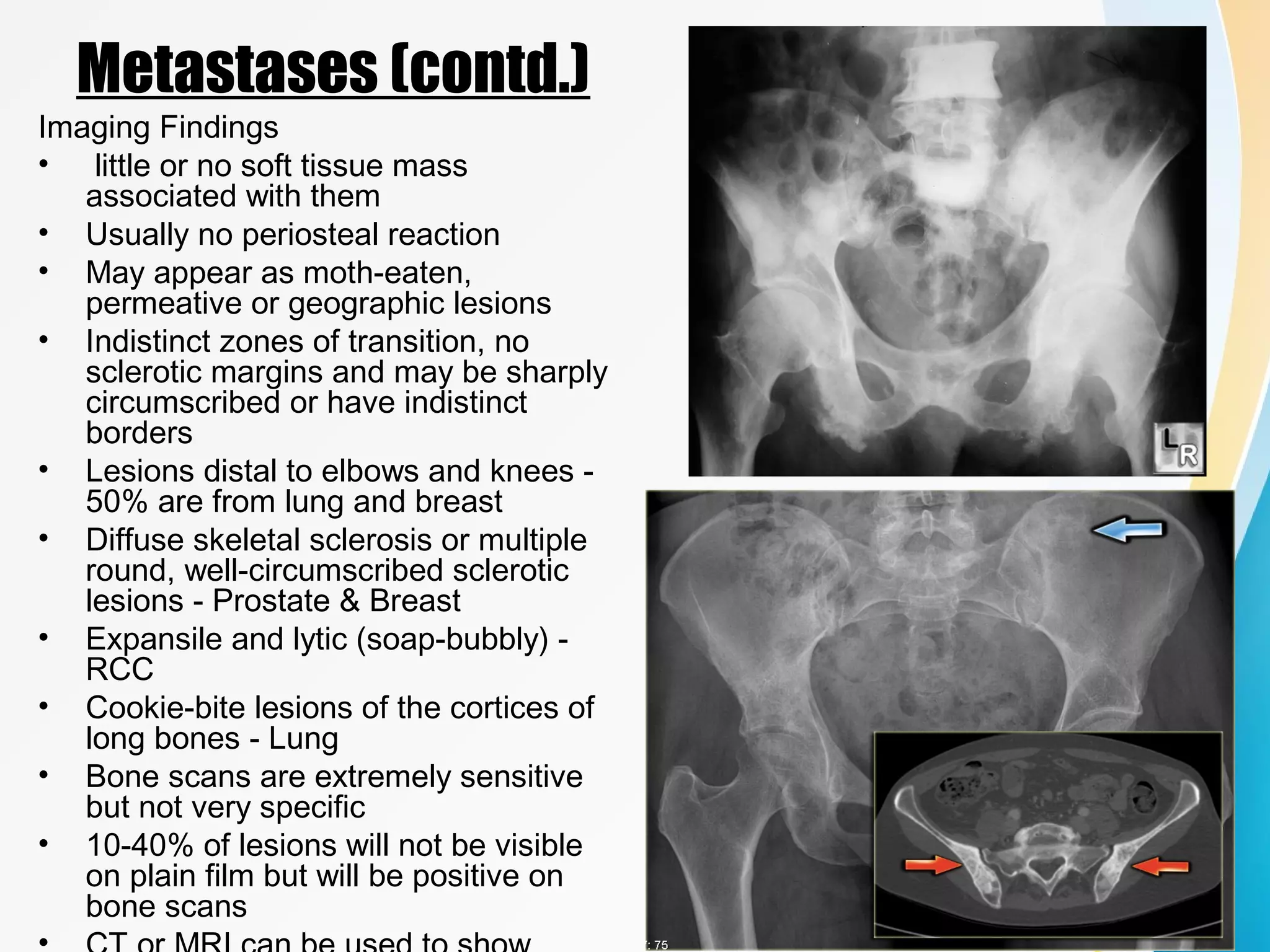 An approach to malignant bone tumors | PPT