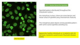 Speckled pattern distributed throughout the
interphase nucleus
the interphase nucleus, there are some denser and
looser areas of speckles (very characteristic feature).
The metaphase plate depicts strong speckled pattern
with some coarse speckles standing out.
Apparently healthy individuals or in patients who do
not have a systemic autoimmune rheumatic disease
(SARD)
DFS70/LEDGF
AC 2 - Nuclear Dense Fine Speckled
 