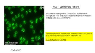 Discrete coarse speckles (40-80/cell) scattered in
interphase cells and aligned at the chromatin mass on
mitotic cells. e.g. anti-CENP-B
Commonly found in patients with limited cutaneous SSc, and as
such included in the classification criteria for SSc
subset of patients with PBC
CENP-A/B (C)
AC 3 – Centromere Pattern
 