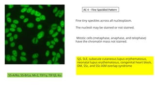 SS-A/Ro, SS-B/La, Mi-2, TIF1γ, TIF1β, Ku
Fine tiny speckles across all nucleoplasm.
The nucleoli may be stained or not stained.
Mitotic cells (metaphase, anaphase, and telophase)
have the chromatin mass not stained.
SjS, SLE, subacute cutaneous lupus erythematosus,
neonatal lupus erythematosus, congenital heart block,
DM, SSc, and SSc-AIM overlap syndrome
AC 4 – Fine Speckled Pattern
 