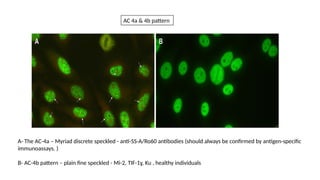 A- The AC-4a – Myriad discrete speckled - anti-SS-A/Ro60 antibodies (should always be confirmed by antigen-specific
immunoassays. )
B- AC-4b pattern – plain fine speckled - Mi-2, TIF-1ɣ, Ku , healthy individuals
AC 4a & 4b pattern
 
