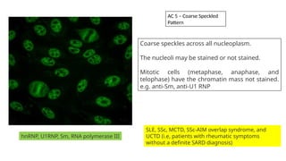 hnRNP, U1RNP, Sm, RNA polymerase III
SLE, SSc, MCTD, SSc-AIM overlap syndrome, and
UCTD (i.e, patients with rheumatic symptoms
without a definite SARD diagnosis)
Coarse speckles across all nucleoplasm.
The nucleoli may be stained or not stained.
Mitotic cells (metaphase, anaphase, and
telophase) have the chromatin mass not stained.
e.g. anti-Sm, anti-U1 RNP
AC 5 – Coarse Speckled
Pattern
 