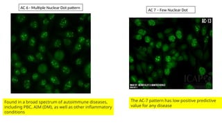 Found in a broad spectrum of autoimmune diseases,
including PBC, AIM (DM), as well as other inflammatory
conditions
AC 6 - Multiple Nuclear Dot pattern
AC 7 – Few Nuclear Dot
The AC-7 pattern has low positive predictive
value for any disease
 