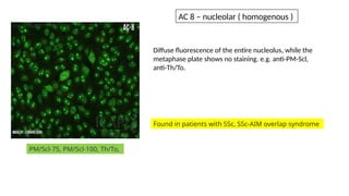 Diffuse fluorescence of the entire nucleolus, while the
metaphase plate shows no staining. e.g. anti-PM-Scl,
anti-Th/To.
PM/Scl-75, PM/Scl-100, Th/To,
Found in patients with SSc, SSc-AIM overlap syndrome
AC 8 – nucleolar ( homogenous )
 