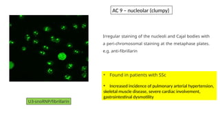 Irregular staining of the nucleoli and Cajal bodies with
a peri-chromosomal staining at the metaphase plates.
e.g. anti-fibrillarin
U3-snoRNP/fibrillarin
• Found in patients with SSc
• Increased incidence of pulmonary arterial hypertension,
skeletal muscle disease, severe cardiac involvement,
gastrointestinal dysmotility
AC 9 – nucleolar (clumpy)
 