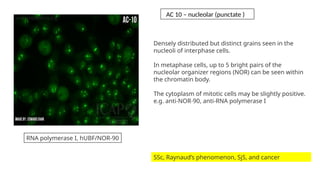 Densely distributed but distinct grains seen in the
nucleoli of interphase cells.
In metaphase cells, up to 5 bright pairs of the
nucleolar organizer regions (NOR) can be seen within
the chromatin body.
The cytoplasm of mitotic cells may be slightly positive.
e.g. anti-NOR-90, anti-RNA polymerase I
SSc, Raynaud’s phenomenon, SjS, and cancer
RNA polymerase I, hUBF/NOR-90
AC 10 – nucleolar (punctate )
 