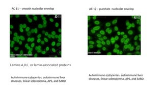 Autoimmune-cytopenias, autoimmune liver
diseases, linear scleroderma, APS, and SARD
Lamins A,B,C, or lamin-associated proteins
AC 11 – smooth nucleolar envelop AC 12 – punctate nucleolar envelop
Autoimmune-cytopenias, autoimmune liver
diseases, linear scleroderma, APS, and SARD
 