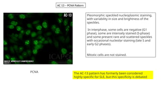 Pleomorphic speckled nucleoplasmic staining,
with variability in size and brightness of the
speckles.
In interphase, some cells are negative (G1
phase), some are intensely stained (S-phase)
and some present rare and scattered speckles
with occasional nucleolar staining (late S and
early G2 phases).
Mitotic cells are not stained.
The AC-13 pattern has formerly been considered
highly specific for SLE, but this specificity is debated
AC 13 – PCNA Pattern
PCNA
 