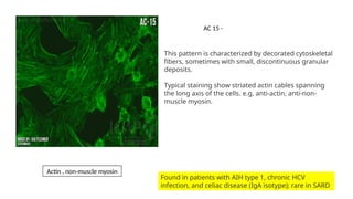 This pattern is characterized by decorated cytoskeletal
fibers, sometimes with small, discontinuous granular
deposits.
Typical staining show striated actin cables spanning
the long axis of the cells. e.g. anti-actin, anti-non-
muscle myosin.
Found in patients with AIH type 1, chronic HCV
infection, and celiac disease (IgA isotype); rare in SARD
Actin , non-muscle myosin
AC 15 -
 