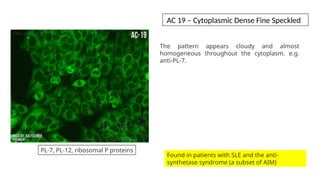 The pattern appears cloudy and almost
homogeneous throughout the cytoplasm. e.g.
anti-PL-7.
Found in patients with SLE and the anti-
synthetase syndrome (a subset of AIM)
PL-7, PL-12, ribosomal P proteins
AC 19 – Cytoplasmic Dense Fine Speckled
 