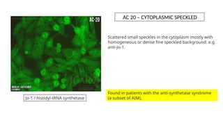 Scattered small speckles in the cytoplasm mostly with
homogeneous or dense fine speckled background. e.g.
anti-Jo-1.
Jo-1 / histidyl-tRNA synthetase
Found in patients with the anti-synthetase syndrome
(a subset of AIM),
AC 20 – CYTOPLASMIC SPECKLED
 
