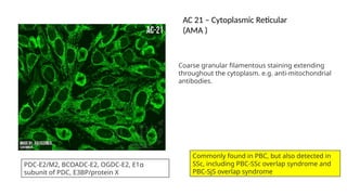 Coarse granular filamentous staining extending
throughout the cytoplasm. e.g. anti-mitochondrial
antibodies.
PDC-E2/M2, BCOADC-E2, OGDC-E2, E1α
subunit of PDC, E3BP/protein X
Commonly found in PBC, but also detected in
SSc, including PBC-SSc overlap syndrome and
PBC-SjS overlap syndrome
AC 21 – Cytoplasmic Reticular
(AMA )
 