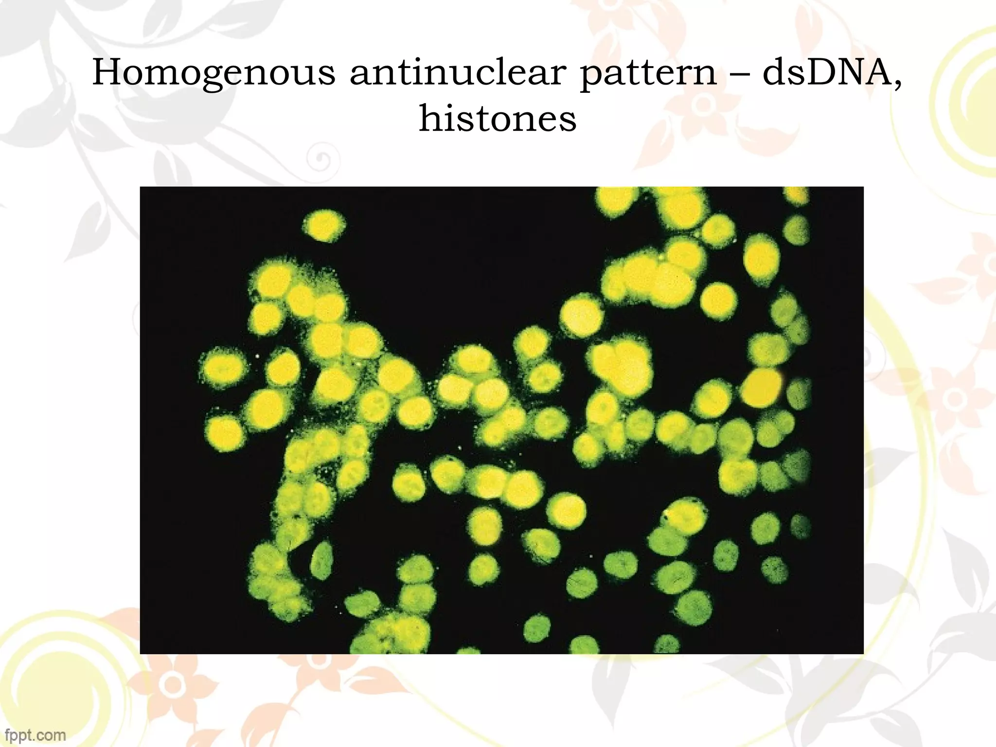 Homogenous antinuclear pattern – dsDNA,
histones
 