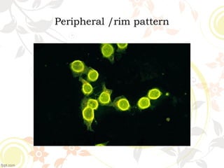 Peripheral /rim pattern
 