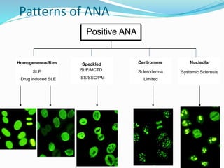 Patterns of ANA
Homogeneous/Rim
SLE
Drug induced SLE
Positive ANA
Speckled
SS/SSC/PM
SLE/MCTD
Centromere
Scleroderma
Limited
Nucleolar
Systemic Sclerosis
 