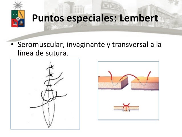 Anastomosis intestinales