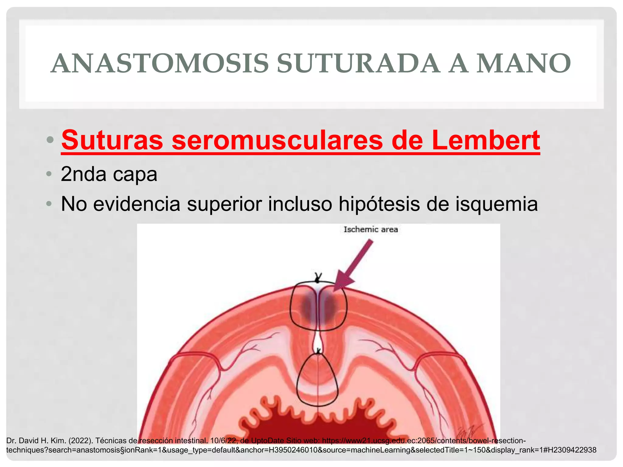 ANASTOMOSIS INTESTINALES.pptx