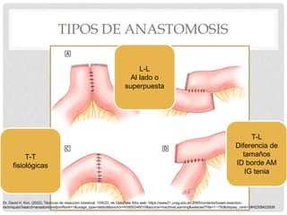 TIPOS DE ANASTOMOSIS
T-T
fisiológicas
L-L
Al lado o
superpuesta
T-L
Diferencia de
tamaños
ID borde AM
IG tenia
Dr. David H. Kim. (2022). Técnicas de resección intestinal. 10/6/22, de UptoDate Sitio web: https://www21.ucsg.edu.ec:2065/contents/bowel-resection-
techniques?search=anastomosis§ionRank=1&usage_type=default&anchor=H3950246010&source=machineLearning&selectedTitle=1~150&display_rank=1#H2309422938
 