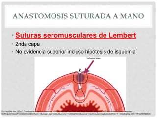 ANASTOMOSIS SUTURADA A MANO
• Suturas seromusculares de Lembert
• 2nda capa
• No evidencia superior incluso hipótesis de isquemia
Dr. David H. Kim. (2022). Técnicas de resección intestinal. 10/6/22, de UptoDate Sitio web: https://www21.ucsg.edu.ec:2065/contents/bowel-resection-
techniques?search=anastomosis§ionRank=1&usage_type=default&anchor=H3950246010&source=machineLearning&selectedTitle=1~150&display_rank=1#H2309422938
 