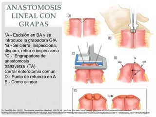 ANASTOMOSIS
LINEAL CON
GRAPAS
*A.- Escisión en BA y se
introduce la grapadora GIA
*B.- Se cierra, inspecciona,
dispara, retira e inspecciona
*C.- Engrapadora de
anastomosis
transversa (TA)
Cerrar enterotomía comun
D.- Punto de refuerzo en A
E.- Como alinear
Dr. David H. Kim. (2022). Técnicas de resección intestinal. 10/6/22, de UptoDate Sitio web: https://www21.ucsg.edu.ec:2065/contents/bowel-resection-
techniques?search=anastomosis§ionRank=1&usage_type=default&anchor=H3950246010&source=machineLearning&selectedTitle=1~150&display_rank=1#H2309422938
 