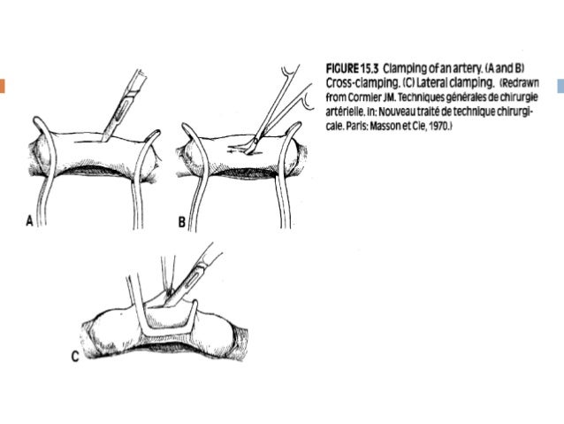 vascular anastomosis