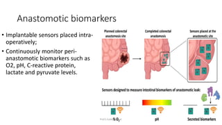 Anastomotic biomarkers
• Implantable sensors placed intra-
operatively;
• Continuously monitor peri-
anastomotic biomarker...