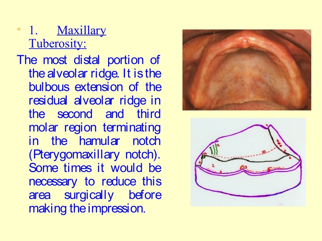 Anatomical landmarks of maxilla / dental implant courses