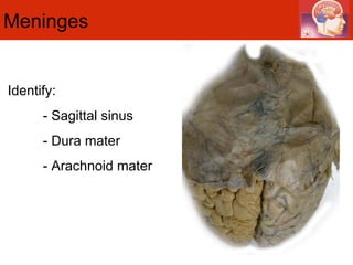 Meninges  Identify: - Sagittal sinus - Dura mater - Arachnoid mater 