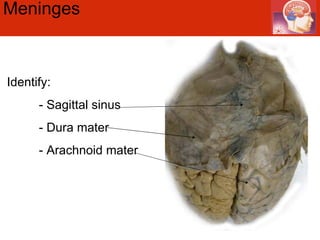 Meninges  Identify: - Sagittal sinus - Dura mater - Arachnoid mater 