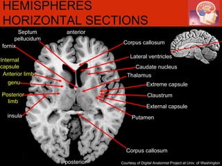 anterior posterior Internal capsule HEMISPHERES HORIZONTAL SECTIONS Courtesy of Digital Anatomist Project at Univ. of Washington Caudate nucleus Lateral ventricles Corpus callosum Thalamus Corpus callosum fornix Septum pellucidum Extreme capsule  External capsule Claustrum insula Putamen Anterior limb genu Posterior limb 