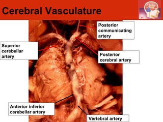 Cerebral Vasculature Posterior communicating artery Superior cerebellar artery Anterior inferior cerebellar artery Vertebral artery Posterior cerebral artery 