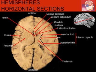 anterior posterior HEMISPHERES HORIZONTAL SECTIONS Lateral ventricles Corpus callosum Thalamus Septum pellucidum Insula anterior limb posterior limb genu Caudate nucleus Putamen Internal capsule fornix 
