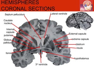 HEMISPHERES CORONAL SECTIONS   Caudate nucleus putamen Internal capsule External capsule extreme capsule clastrum insula Globus pallidus Lateral ventricle Septum pellucidum fornix hypothalamus 3 rd  ventricle 