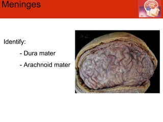 Meninges  Identify: - Dura mater - Arachnoid mater 